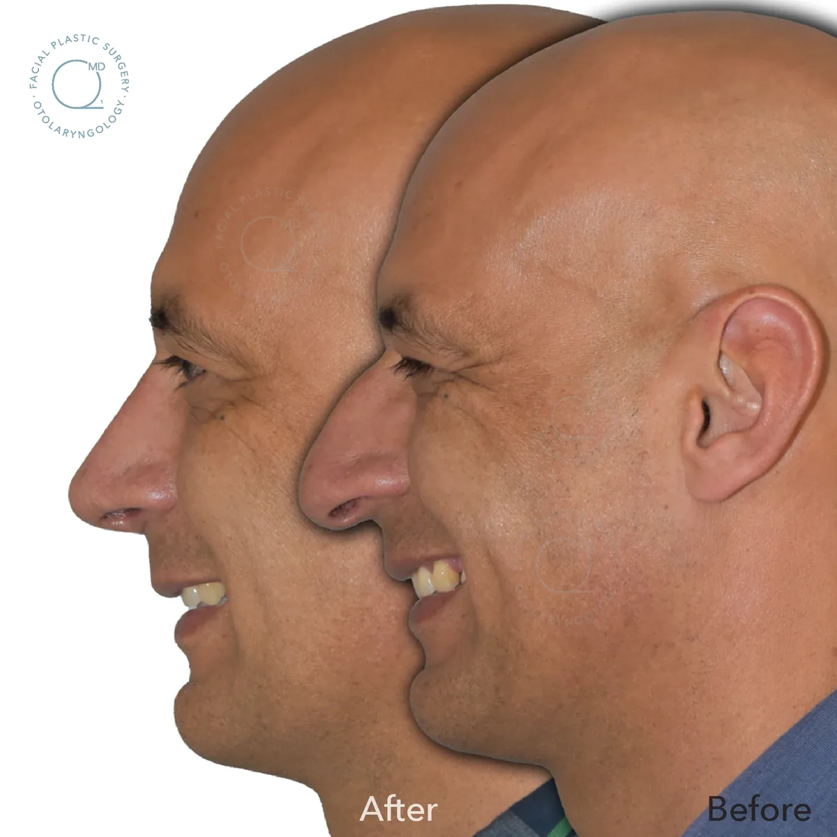 Rinoplastia cerrada resultado · Paciente 3